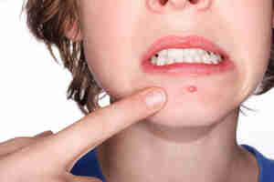 how to pop a pimple