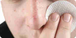 Acne clear naturally