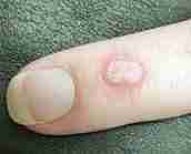 Remove warts with duct tape