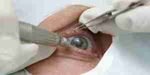 Cataract surgery recovery: cataract removal and treatment